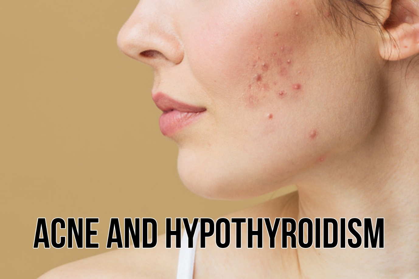 Acne and Hypothyroidism – Relation