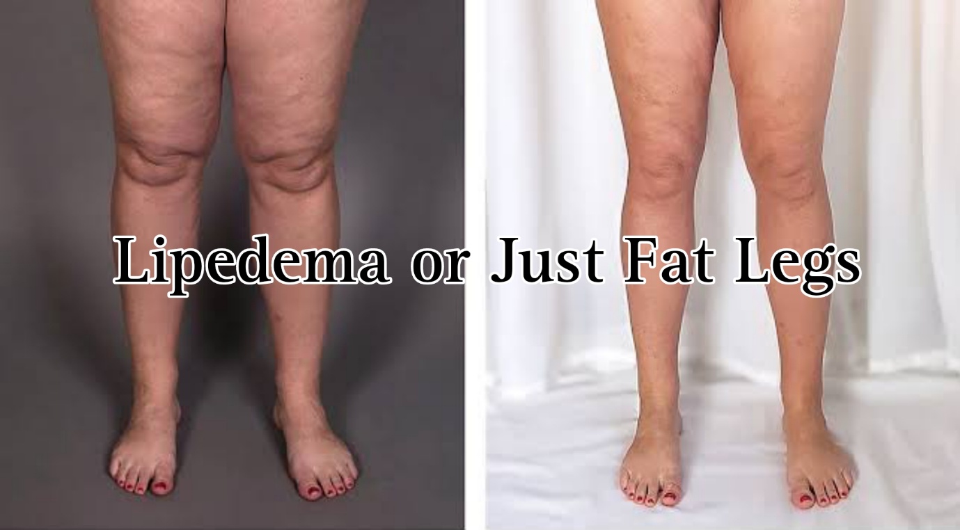Lipedema Or Just Fat Legs | Are You Overweight, Or Have Lipedema?